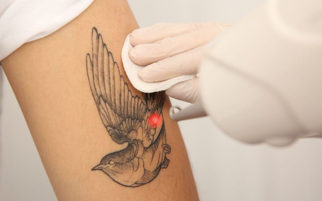 The Ultimate Guide to Laser Tattoo Removal in Bristol: Everything You Need to Know