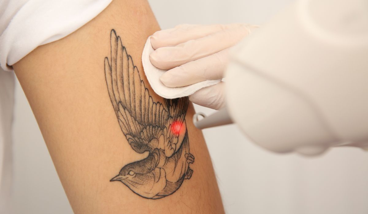 Laser Tattoo Removal Bristol